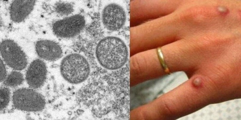 Paraíba investiga novo caso suspeito de Mpox; Brasil ultrapassa mil confirmados - Imagem: Reprodução / Twitter Paraíba investiga novo caso suspeito de Mpox; Brasil ultrapassa mil confirmados - Imagem: Reprodução / Twitter
